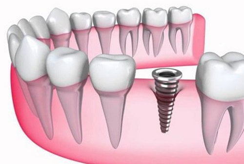 Chi phí làm răng giả cố định implant 2