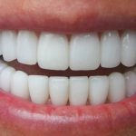 Chi phí trồng răng sứ vĩnh viễn