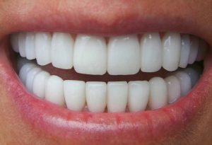 Chi phí trồng răng sứ vĩnh viễn