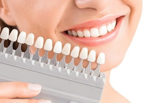 Có nên bọc răng sứ thẩm mỹ? Thông tin nha khoa hữu ích 2