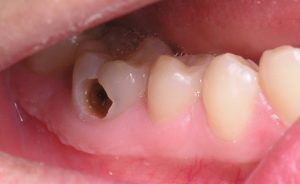 công thức chữa sâu răng hiệu quả