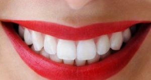 Nên bọc răng sứ hay cấy ghép implant