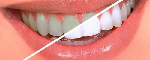 Nên tẩy trắng răng bằng phương pháp nào thì tốt? 1