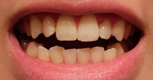 Nên tẩy trắng răng bằng phương pháp nào thì tốt? 2