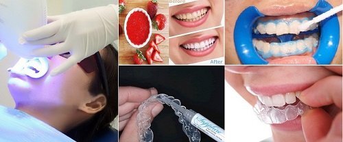 Nên tẩy trắng răng bằng phương pháp nào thì tốt? 4