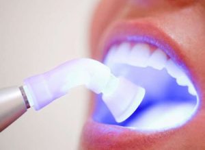 những cách làm trắng răng tại nha khoa hiện nay