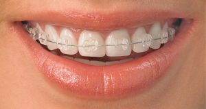 niềng răng giá rẻ ở đâu tại tphcm