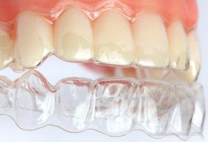 Niềng răng tháo lắp giá bao nhiêu