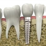 Phẫu thuật nâng xoang hàm trong cấy ghép implant