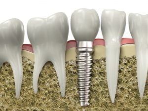 Phẫu thuật nâng xoang hàm trong cấy ghép implant