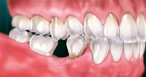 Quá trình cấy ghép implant cho răng cửa 2
