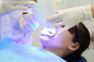 quy trình tẩy trắng răng bằng laser như thế nào