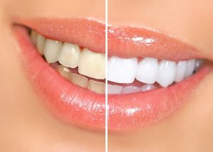 Răng sứ có tẩy trắng được không?