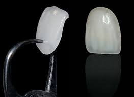 răng sứ veneer là gì