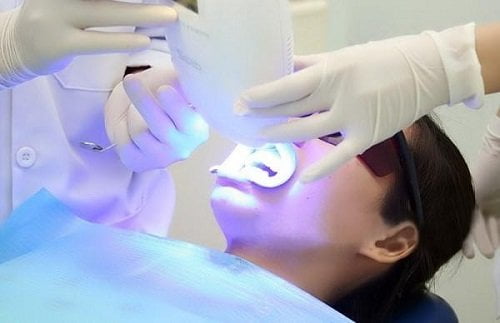 Tẩy trắng răng bằng đèn plasma - Công nghệ hiện đại 2