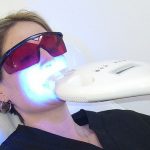 Tẩy trắng răng bằng laser bao nhiêu tiền?