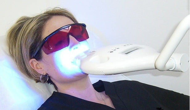 Tẩy trắng răng bằng laser bao nhiêu tiền? 