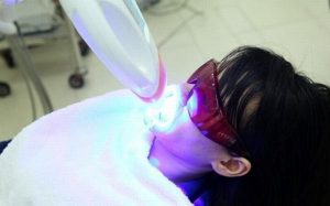tẩy trắng răng bàng laser có hại không