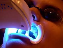 tẩy trắng răng bàng laser có hại không