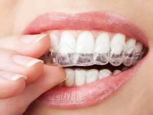 tẩy trắng răng có đau không