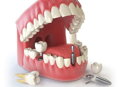 Trồng răng cửa implant giá bao nhiêu? 1
