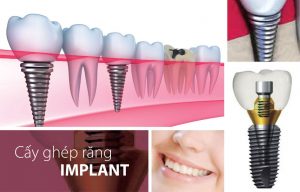 Trồng răng giả cố định implant giá bao nhiêu?
