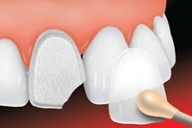 ưu và nhược điểm của các loại răng sứ