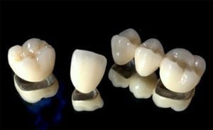 ưu và nhược điểm của các loại răng sứ