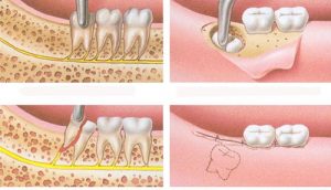 Cách điều trị răng khôn mọc lệch 90 độ hiệu quả