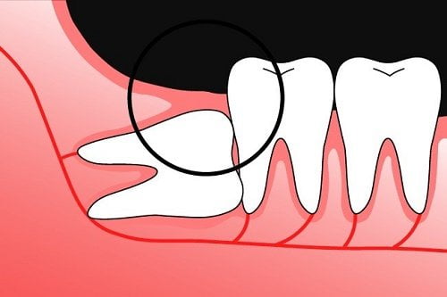Mọc răng khôn phải làm sao? 2