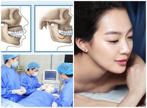 Phẫu thuật chỉnh hàm hô 