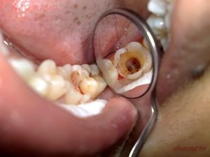 Răng khôn bị sâu có nên nhổ không?