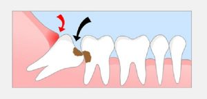Răng khôn hàm trên mọc lệch phải làm sao?