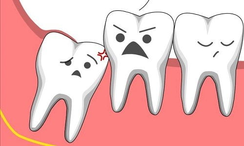 Răng khôn mọc trong thời gian bao lâu thì hoàn thiện? 1