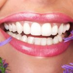 Tẩy trắng răng thẩm mỹ