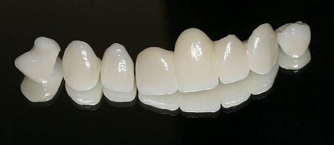 ưu và nhược điểm của răng sứ cercon