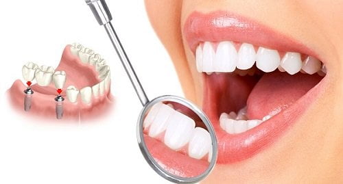 Giải đáp thắc mắc: Trồng răng có ảnh hưởng gì không? 2