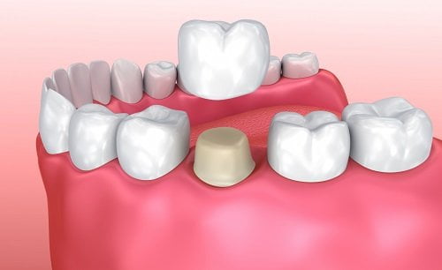 Giải đáp thắc mắc: Trồng răng có ảnh hưởng gì không? 3