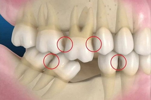 Những điều cần lưu ý khi trồng răng cửa hàm dưới 1