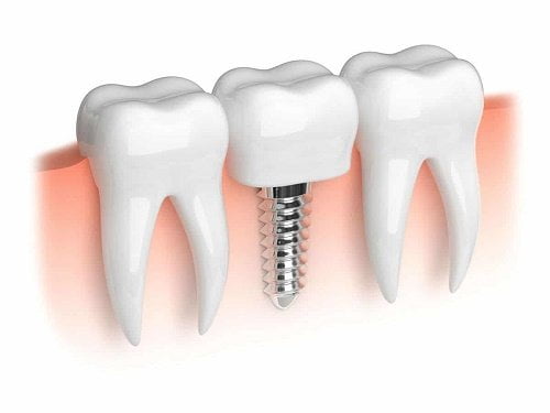 Trồng răng cấm hết bao nhiêu tiền? Nha khoa tư vấn 2