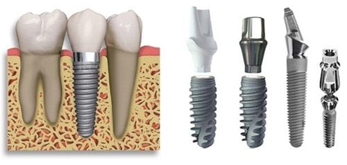 Kinh nghiệm làm răng implant cho bạn hiệu quả 2