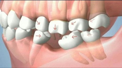 Trồng răng giả hàm dưới cần lưu ý điều gì? 1