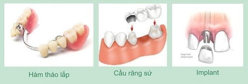 Trồng răng giả hàm dưới cần lưu ý điều gì? 2