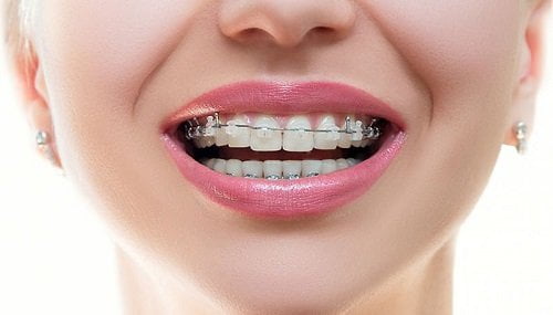 Địa chỉ niềng răng tốt nhất và uy tín hiện nay