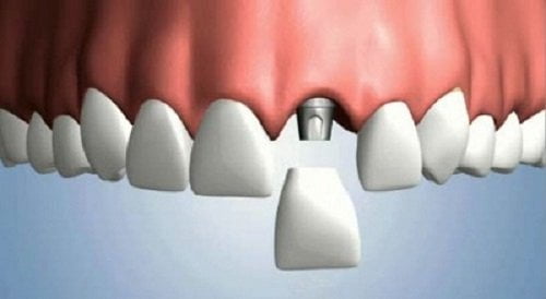 Mất 1 răng cửa phải làm sao để khắc phục hiệu quả an toàn?