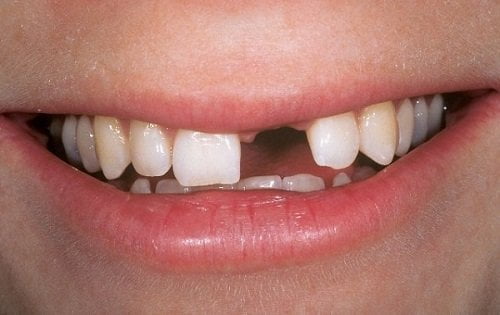 Mất 1 răng cửa phải làm sao để khắc phục hiệu quả an toàn?