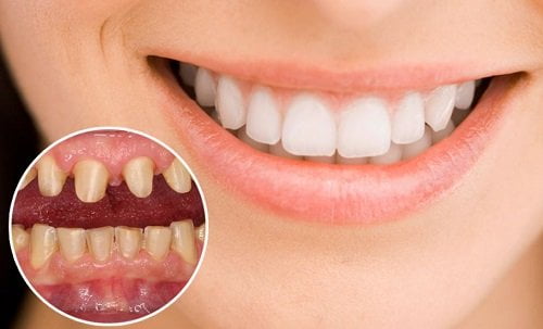 Bọc răng sứ bị cộm - Nguyên nhân chính do đâu? 1