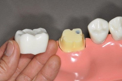 Bọc răng sứ bị cộm - Nguyên nhân chính do đâu? 2