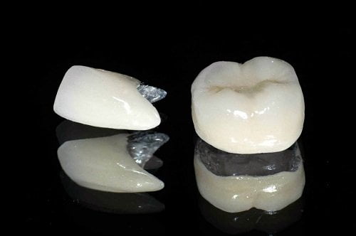 Bọc răng sứ titan có tốt không? Tìm hiểu răng sứ titan 1