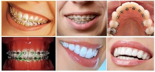 Niềng răng hàm trên giá bao nhiêu tại nha khoa uy tín? 3